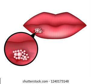 Herpes on the lip. Infographics. Vector illustration on isolated background.