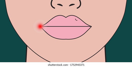 Herpes on lip. Red inflammation on lip of woman. Vector illustration