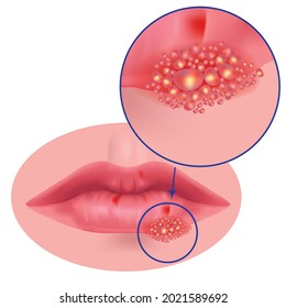 herpes on the lips close up. Vector medical illustration