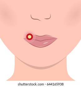 Herpes On The Woman Face. Swollen Lips. Cold Sore Icon. Vector Illustration Flat Design