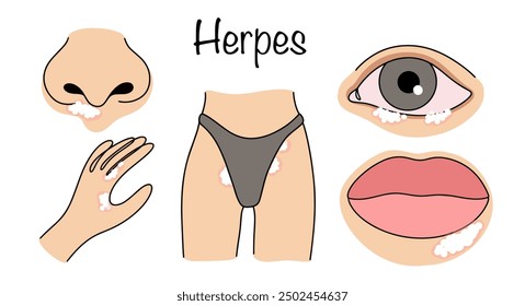 Herpes rashes on the mucous membranes of the eyes, nose and mouth, as well as in the genital area and on the hands. A common viral disease. Simple color vector illustration.