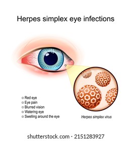 Herpes simplex eye infections. A red human's eye with Swelling around. close-up of Herpes simplex virus. virions that caused infection disease of eye. vector illustration