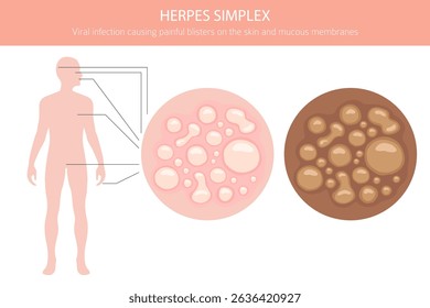Herpes Simplex. Skin diseases. Medical infographic design. Vector illustration
