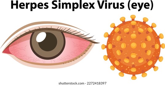 Herpes simplex virus (Eye) illustration
