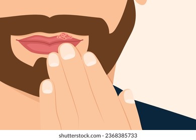 infección por virus herpes simple en labios machos- ilustración vectorial
