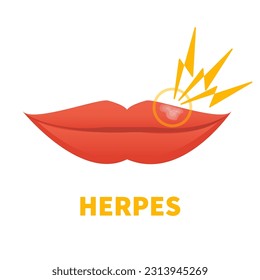 Virus Herpes Simplex en los labios. Brote de dolores fríos. Enfermedad oral. Tratamiento de lesiones herpéticas. Concepto médico. Ilustración vectorial aislada en blanco.