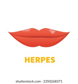 Herpes Simplex Virus on lips. Cold sore outbreak. Oral disease. Herpetic lesions treatment. Medical concept. Vector illustration isolated on white. 