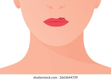 Virus del herpes simple en los labios; síntomas contagiosos del herpes labial, ampollas en los labios e infecciones virales de la piel ideales para fines educativos, de atención médica y de prevención - Ilustración vectorial
