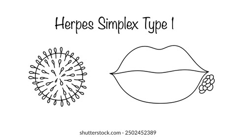 Virus del herpes tipo 1 que causa una erupción en los labios. Enfermedad infecciosa viral. Ilustración dibujada a mano sobre un tema médico.