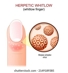 Herpetic whitlow. whitlow finger. Human's finger with skin disease. Close-up of virions of Herpes simplex virus. vector illustration