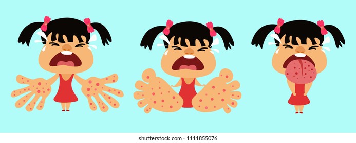 HFMD children infected. hand foot and mouth disease. Girl infected enterovirus. Cartoon vector illustration