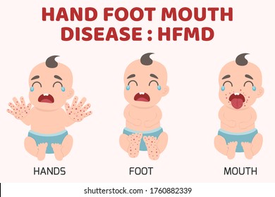 HFMD children infected. Hand-foot-mouth disease Infographics with symptoms. cartoon health concept vector illustration.