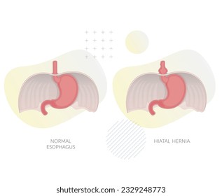 Hiatal Hernia - Hiatus Opening in Diaphragm - Stock Illustration as EPS 10 File