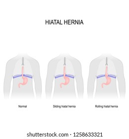 Hiatal hernia. Vector diagram of different types of hiatus hernia. Normal anatomy, sliding hiatal hernia, and rolling (paraesophageal) type of hernia. illustration for biological, science, medical use