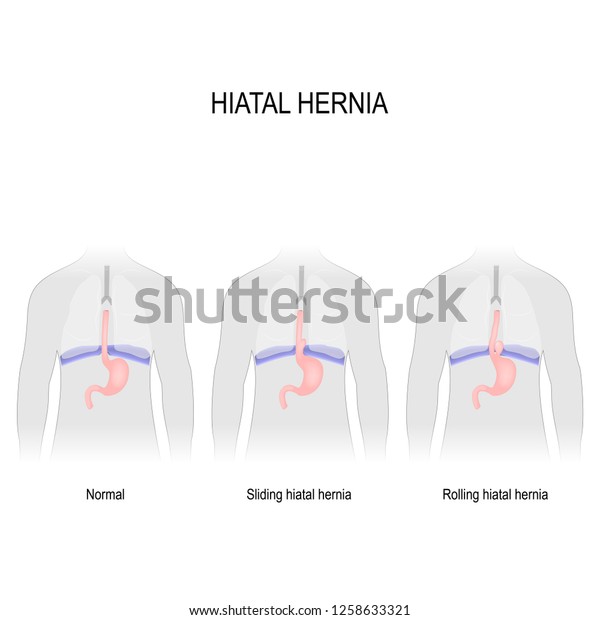 Hiatal Hernia Vector Diagram Different Types 스톡 벡터로열티 프리 1258633321