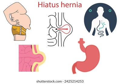 hiatus hernia,hiatal hernia,part of the stomach squeezes up into the chest through an opening in the diaphragm,Stomach,illustration for biological, science, and medical use,overweight