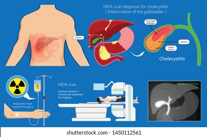 Análisis HIDA diagnóstico tratamiento escintigrafía hepática células inyectables escáner pruebas de fugas congénitas anormales abdomen imágenes agudas bloqueadas radiología