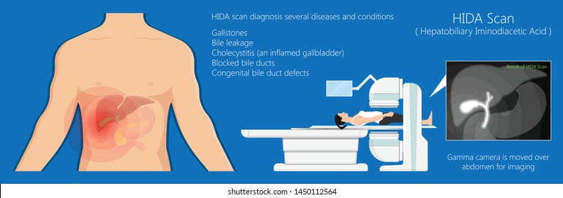 Hida Scan Diagnosis Treat Liver Scintigraphy Stock Vector (Royalty Free ...