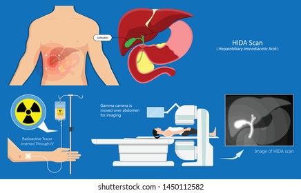 HIDA scan diagnosis treat liver scintigraphy inject cells scanner congenital abnormal leaks test abdomen acute imaging blocked radiology hepatobiliary iminodiacetic acid transplant gallstones 