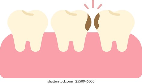 Caries dental oculta Caries dental cariosa