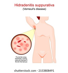 Hidradenitis suppurativa. acne inversa is a painful skin condition that causes abscesses and scarring on the skin. affected areas of Verneuil's disease. Vector poster