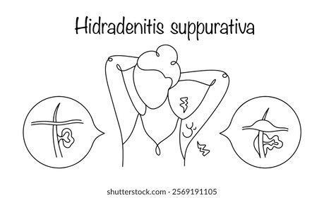 Hidradenitis suppurativa. Purulent inflammation of the apocrine sweat glands of a chronic nature. A drawn woman with healthy sweat glands in the armpit area and a manifestation of the disease. Vector.