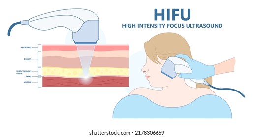 HIFU High Intensity Focus Ultrasound face saggy skin treat cell body lift laser hair firm tightening brow toxin droopy double chin scar