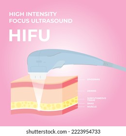 HIFU spa treatment. High intensity focus ultrasound. SMAS ultrasound face lifting with hardware. Face saggy skin treat. Cell body lift. Double chin lift. Facial medical procedure. Cutaway skin diagram