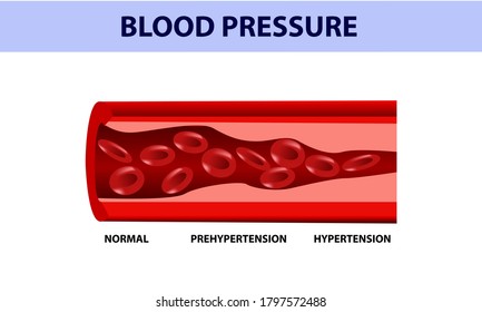 High Blood Pressure. Cross Section Of A Blood Vessel, Medical Illustration