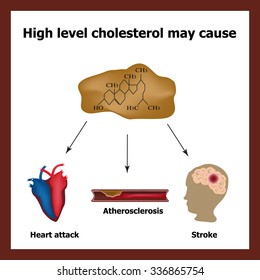 High cholesterol causes - heart attack, stroke, atherosclerosis. Chemical formula cholesterol. Cholesterol plaques. Infographics. Vector illustration.