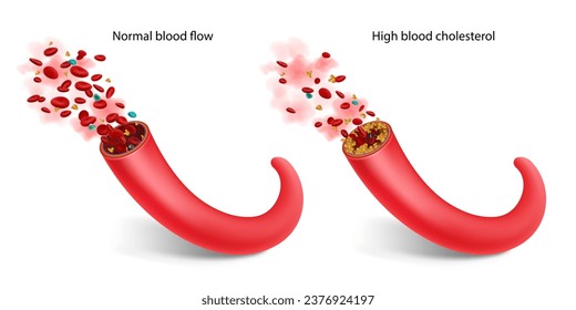 Colesterol alto. Ilustración vectorial aislada