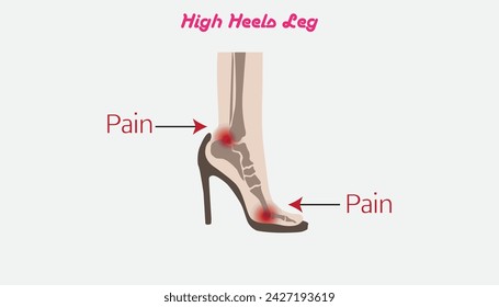 high heeled, Deformation of the foot bones in high heeled shoes,schematic vector illustration, structure, anatomy, inforgraphic, isolated on wihte,Medical science educational illustration. 