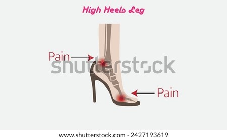 high heeled, Deformation of the foot bones in high heeled shoes,schematic vector illustration, structure, anatomy, inforgraphic, isolated on wihte,Medical science educational illustration. 