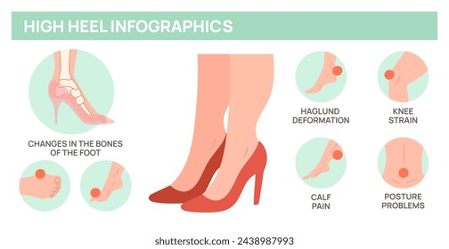 High heels harm for female feet. Foot disease medical poster. Deformity of bones and joints. Orthopedic problem. Uncomfortable woman footgear. Anatomy infographic. Garish