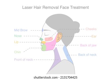 Highlight on woman's face area to do laser hair removal treatments. Illustration about diagram for a beauty treatment with laser.