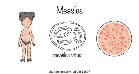 Enfermedad vírica aguda altamente contagiosa que se transmite por gotículas en el aire y ocurre con mayor frecuencia en niños. Vector médico sobre fondo blanco.