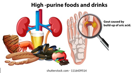 High-Purine Foods and Drinks illustration