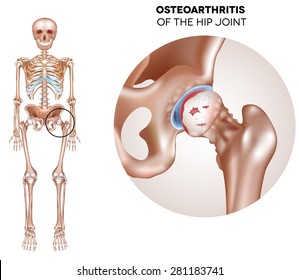 Hip Arthritis, damaged joint cartilage and osteophytes.