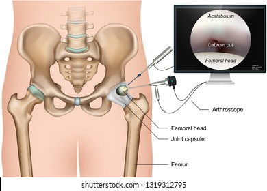 Hip arthroscopy 3d medical vector illustration on white background