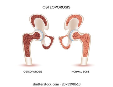 Anatomía ósea y biología de la cadera, hueso sano e insalubre, osteoporosis. Concepto médico o de salud. Aislado sobre un fondo blanco. Ilustración realista del vector 3d 