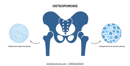 Hip bone fracture poster. Leg injury concept. Broken femur bone, systemic skeletal disorder, loss of mineral density, osteoporosis disease. Deterioration of bone tissue x ray flat vector illustration