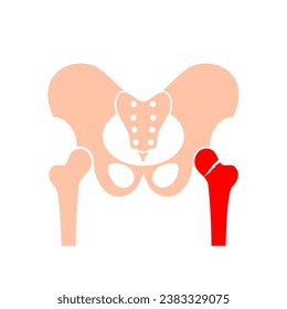 Afiche de fractura de hueso de cadera. Concepto de lesión de la pierna. Hueso de fémur roto, trastorno esquelético sistémico, pérdida de densidad mineral, enfermedad por osteoporosis. Deterioro del tejido óseo x raya de ilustración vectorial plana