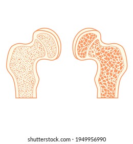 Hip bone. healthy and with osteoporosis. Vector illustration Osteoporosis of hip bone