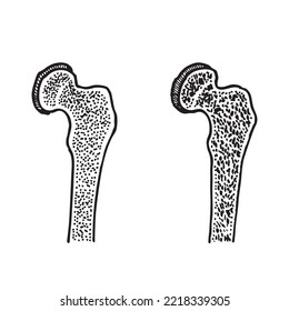 Hueso de cadera sano y con osteoporosis.Ilustración vectorial  