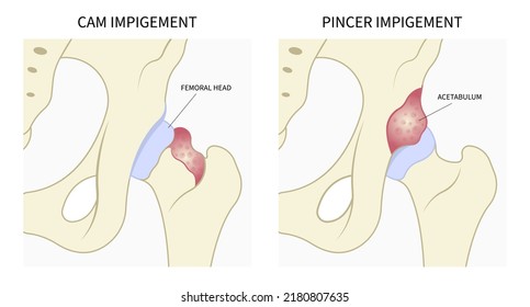 Hip Bone Pain Range Of Motion Groin Head Tear Treat Joint Thigh Femur Injury Spurs Socket Lesion