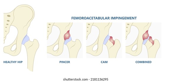 Hip Bone Pain Range Of Motion Groin Head Tear Treat Joint Thigh Femur Injury Spurs Socket Lesion