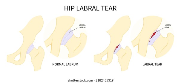 Hip Bone Pain Range Of Motion Groin Head Tear Treat Joint Thigh Femur Injury Spurs Socket Lesion