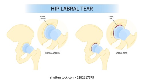 hip bone Pain range of motion groin head tear Treat joint thigh femur injury spurs socket lesion