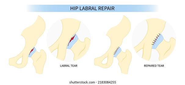 Hip Bone Pain Range Of Motion Groin Head Tear Treat Joint Thigh Femur Injury Spurs Socket Lesion