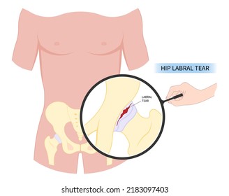 Hip Bone Pain Range Of Motion Groin Head Tear Treat Joint Thigh Femur Injury Spurs Socket Lesion